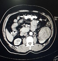 ورم بالكليه اليسري